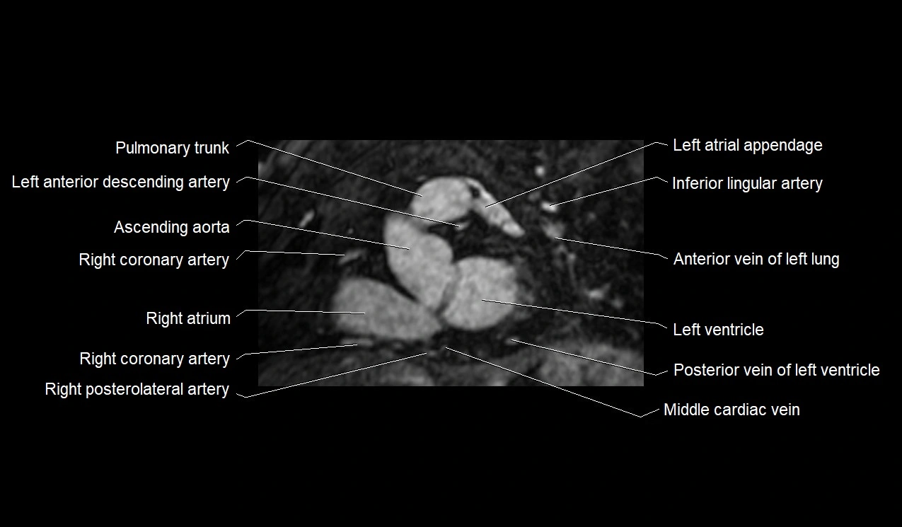 MRI heart and coronary arteries short axis anatomy image 17.webp